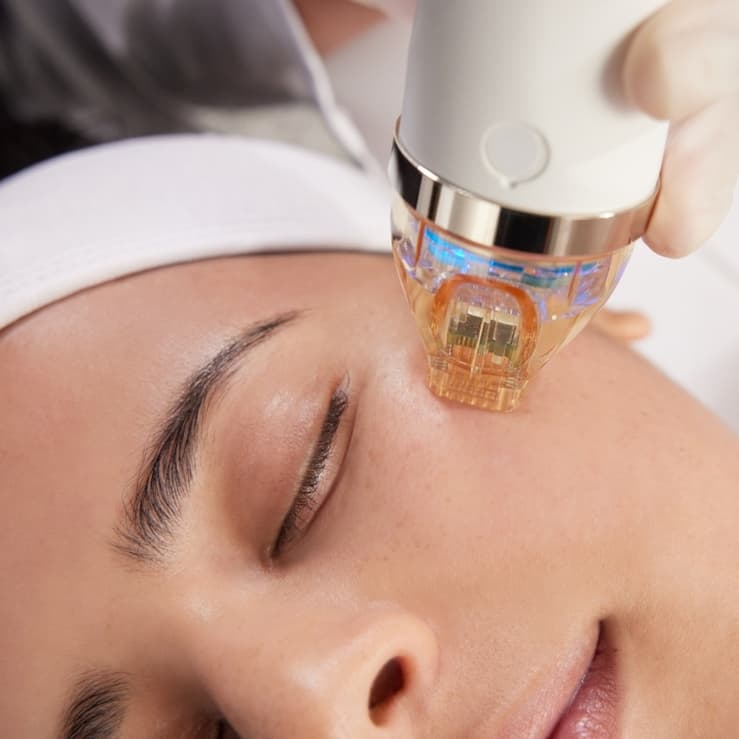 RF Microneedling